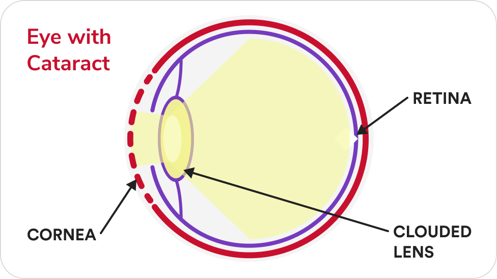 Eye with cataract